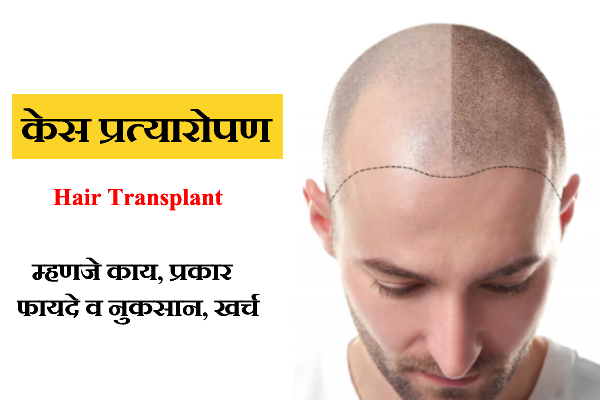 Hair Transplant Detail Information in Marathi