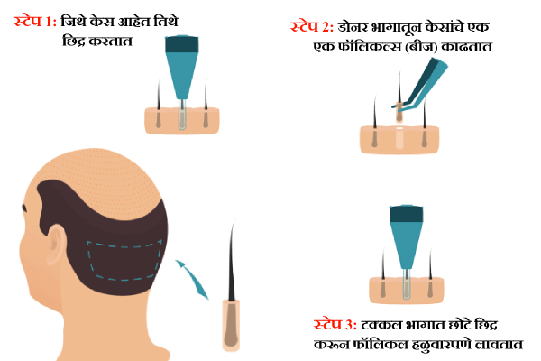 Hair Transplant FUE Information in Marathi