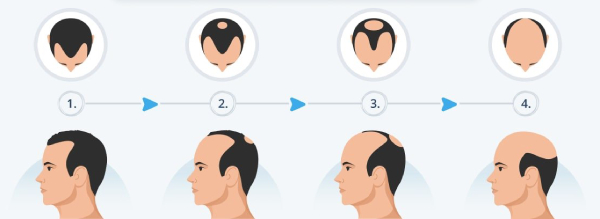 Male Pattern Baldness information in Marathi