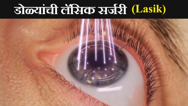 Lasik Surgery Sampurn Mahiti