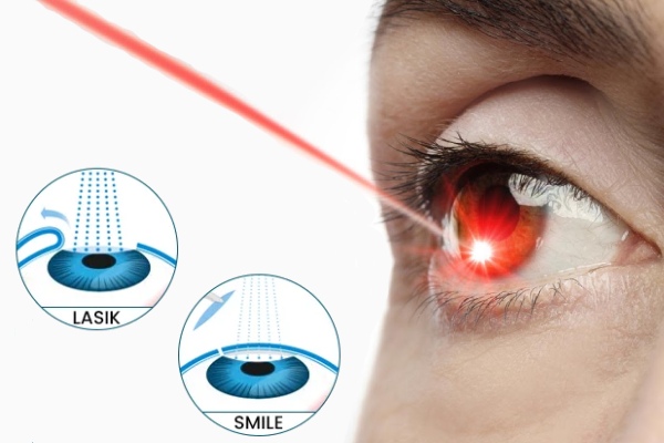 Types of Lasik Surgery